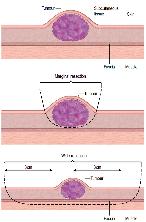 BIOPSIA INCISIONAL Y EXCISIONAL PDF